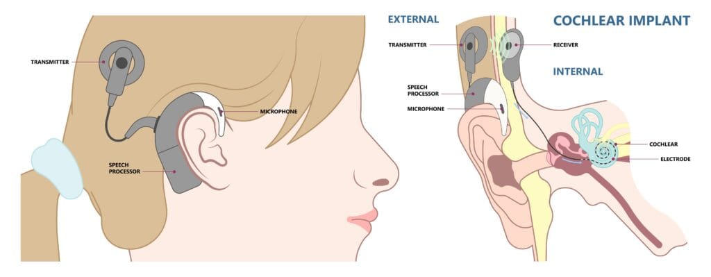 Illustration of BAHA implant when it is fixed.