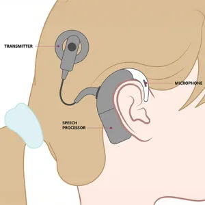 Bone anchored hearing aid
